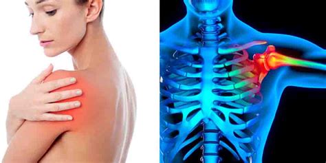 Постоянная боль в плечевом суставе - причины и лечение